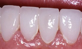 Flawlessly repaired bright white teeth