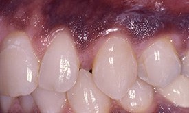 Teeth with large gaps between them