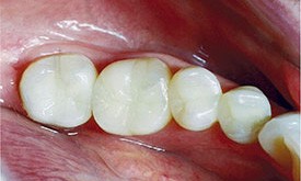 Dark silver fillings replaced with tooth-colored fillings