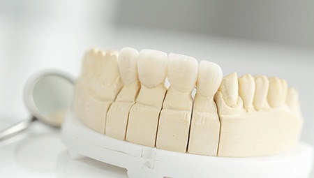 Model of dental implant bridge