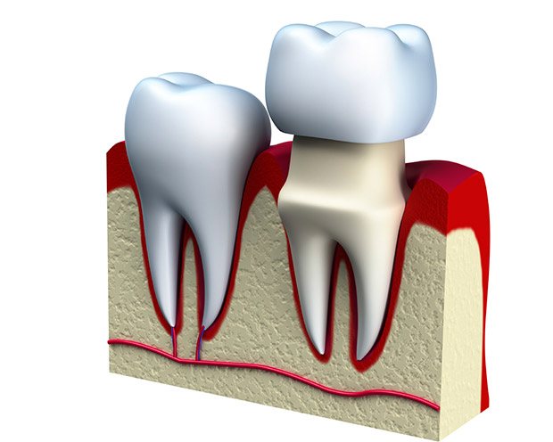 Animation of dental crown restoration
