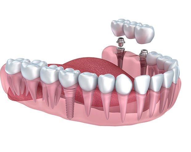 Animated image of smile with implant supported bridge