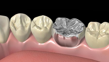 Animation of smile with one metal crown