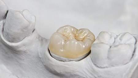 Ceramic tooth model with porcelain crown restoration