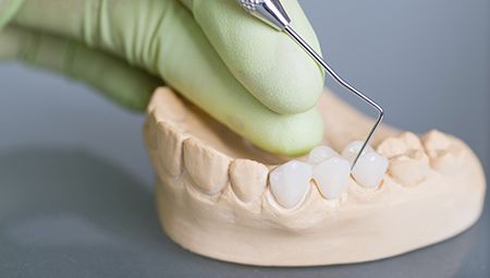 Model of teeth with fixed bridge restoration