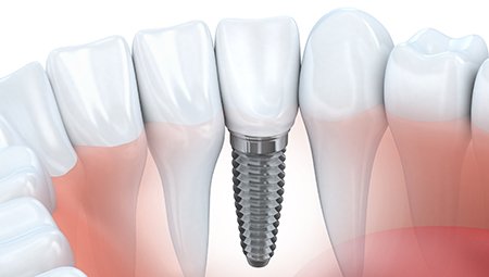 Animation of implant supported dental crown