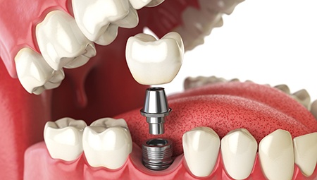 Animation of implant supported dental crown placement