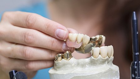 Model of smile with implant retained partial