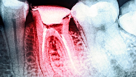 X-ray of root canal treated tooth