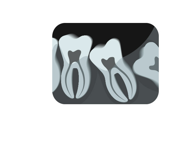 Animation of impacted wisdom tooth x-ray