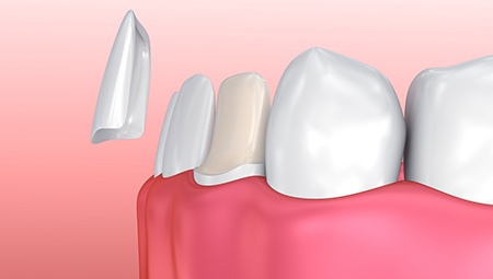 Animation of porcelain veneer placement